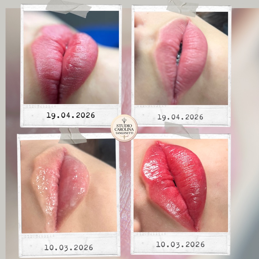 Antes y después de micropigmentación de labios